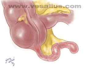 Appendicitis Appendix is a vestigial organ in RLQ Obstruction of the lumen may lead to swelling Appendicitis Appendix is a