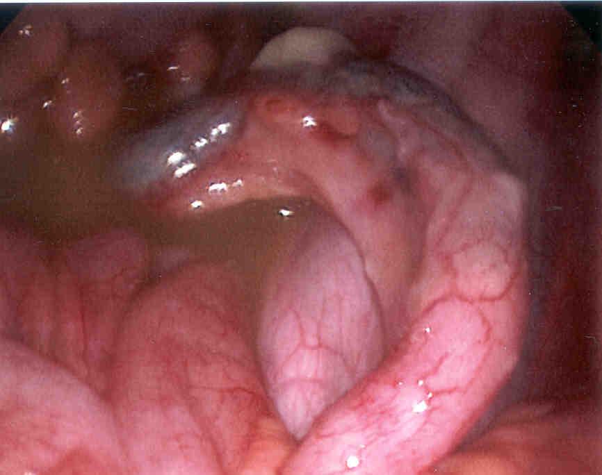 Appendicitis Appendix is a vestigial organ in RLQ Obstruction of the lumen may lead to swelling Pressure in the lumen builds