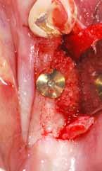REPORT CASE REPORT Augmentation of a dehiscence-type defect around dental implant TECHNOLOGY scco 2 cleaning process as basis for optimal matrix properties and maximal graft safety