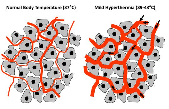 HYPERTHERMIA AND CHEMOTHERAPY HEAT Increase of blood flow; Increase