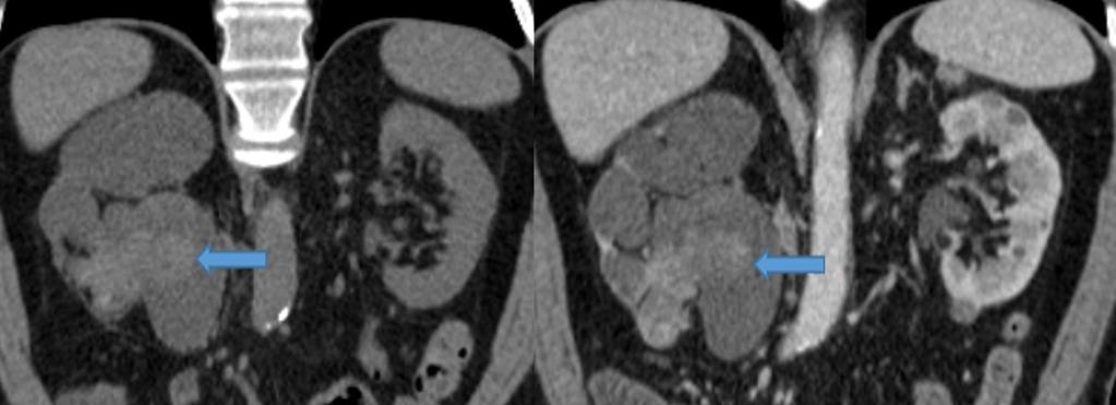Fig. 8: Hyperattenuating lesion (right image) in the right kidney pelvis and the inferior calyces that enhances after