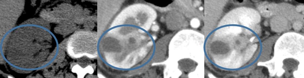 4. Metastases - Metastatic disease to the kidney is the most common renal malignancy with lung, breast, and gastrointestinal tumors and melanoma representing the most common.
