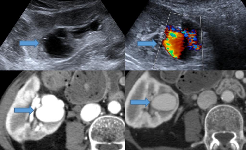 Fig. 11: Arteriovenous malformation in the right kidney: On the bottom images is depicted a well defined lesion that has the same enhancement of the aorta in the arterial and venous phases.