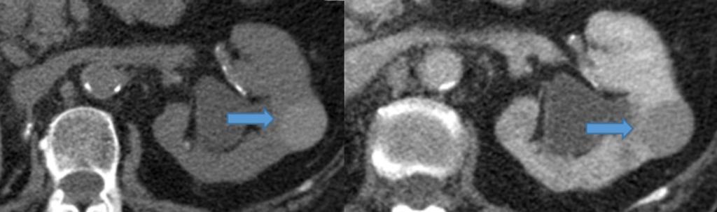 Category I - Benign simple cyst - Simple fluid attenuation( 0-20 HU), Hairline-thin smooth wall, - No septa, calcification, or soft tissue component Category II - Benign, minimally complicated cyst -