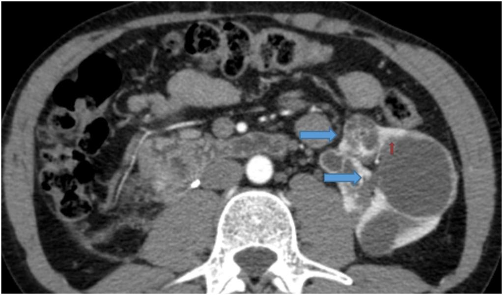 Fig. 6: Two indeterminate cystic lesion in the left kidney (arrows). The smaller one has several irregular, tick and enhancing septa. The larger lesion has a tick, irregular and enhancing wall.
