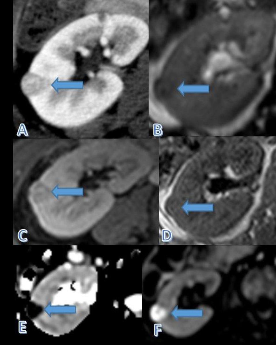 Fig. 12: Renal cell carcinoma: small solid enhancing lesion (arrow) depicted in enhanced TC (A), T2 weighted MRI (B), after gadolinium