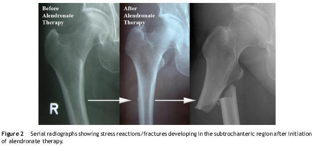 SEQUENCE OF X-RAY CHANGES (Kwek 2008) 2008: Ernest Kwek 1 May 2005 to 31 January 2007: 17 patients with a low energy subtrochanteric femur fracture on alendronate therapy.