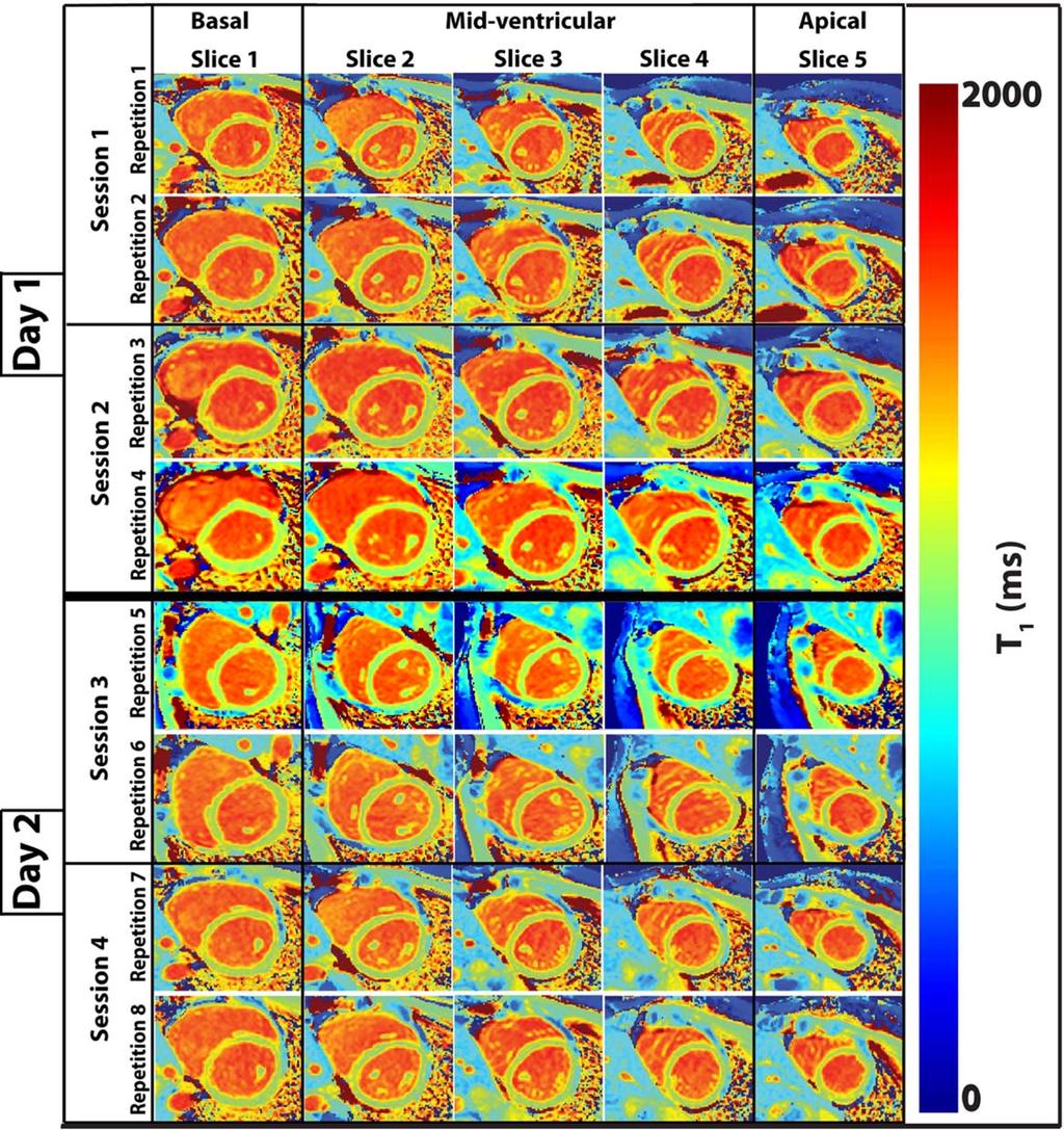 Journal of Magnetic Resonance Imaging FIGURE 2: Example T 1 maps acquired with the STONE sequence. Each of the three most basal sections were divided into six segments of 608 each.