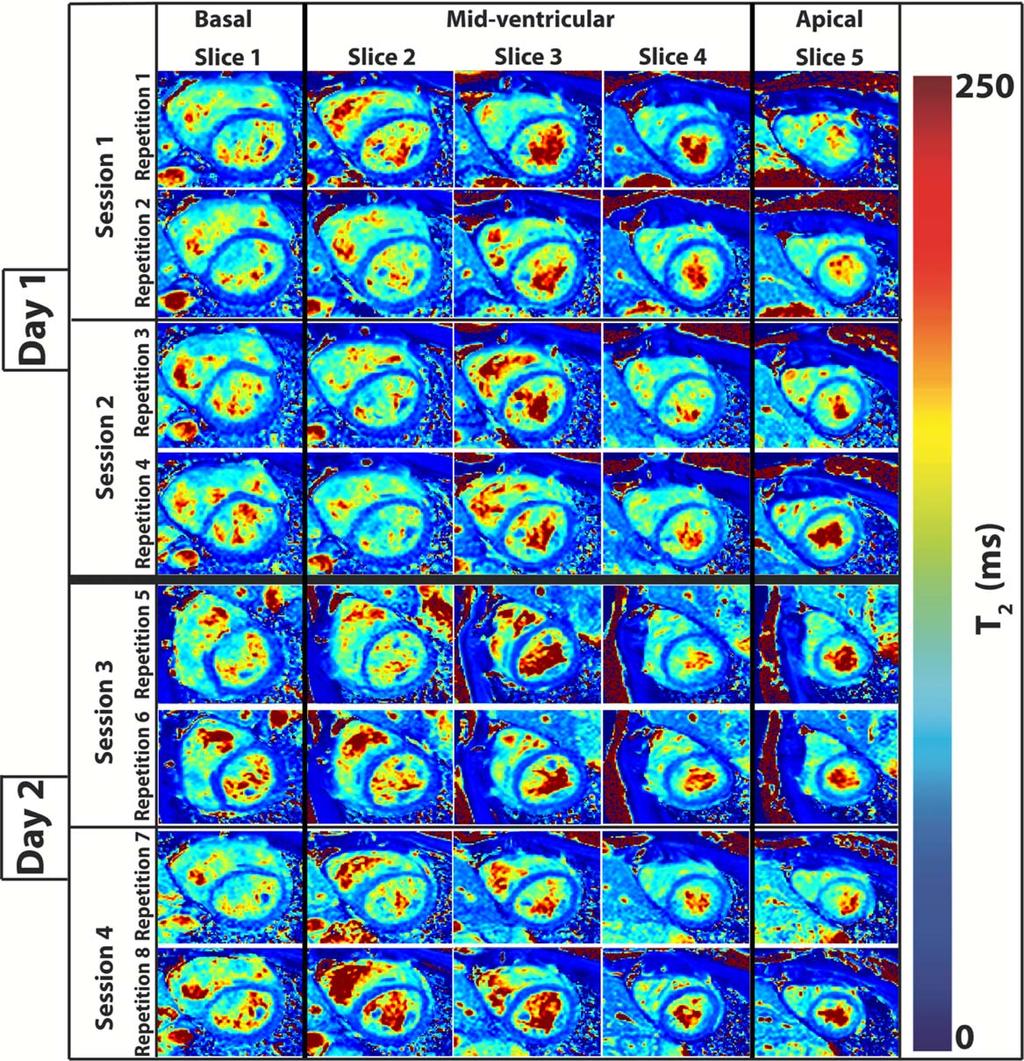 Bellm et al.: Reproducibility of Myocardial T 1 and T 2 Maps FIGURE 3: Example T 2 maps acquired with the free-breathing slice-interleaved T 2 mapping sequence. excluded (T 1 : 5.6% and T 2 : 16.3%).
