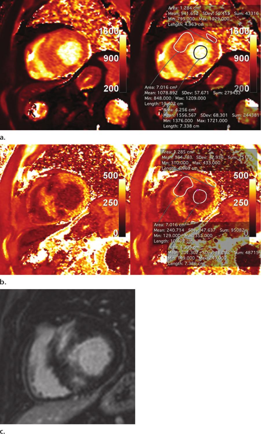 RG Volume 34 Number 6 Hamlin et al 1603 Figure 7. T1 mapping in a 55-year-old man with septal hypertrophic cardiomyopathy. (a) Short-axis nonenhanced MOLLI (1.