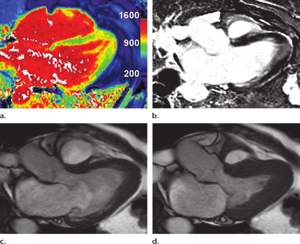 1604 October Special Issue 2014 radiographics.rsna.org Figure 8. T1 mapping in a 65-year-old man with apical variant hypertrophic cardiomyopathy that was initially detected at electrocardiography.