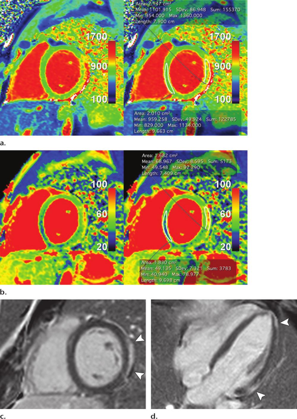 RG Volume 34 Number 6 Hamlin et al 1605 Figure 9. T1 and T2 mapping in an 18-year-old man with myopericarditis. (a, b) Short-axis nonenhanced MOLLI T1 (a) and SSFP T2 (b) maps obtained at 1.
