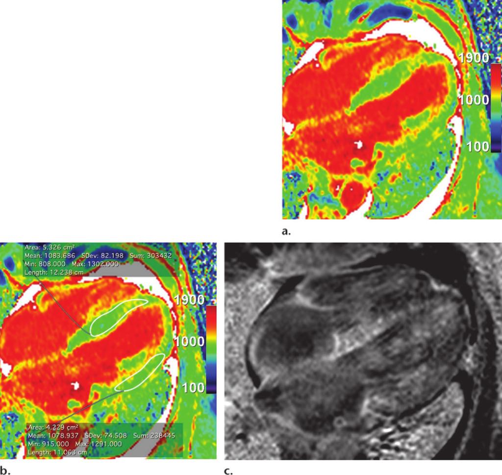 1606 October Special Issue 2014 radiographics.rsna.org Figure 10. T1 mapping in a 68-year-old woman with AL amyloidosis and cardiac involvement confirmed at endomyocardial biopsy.