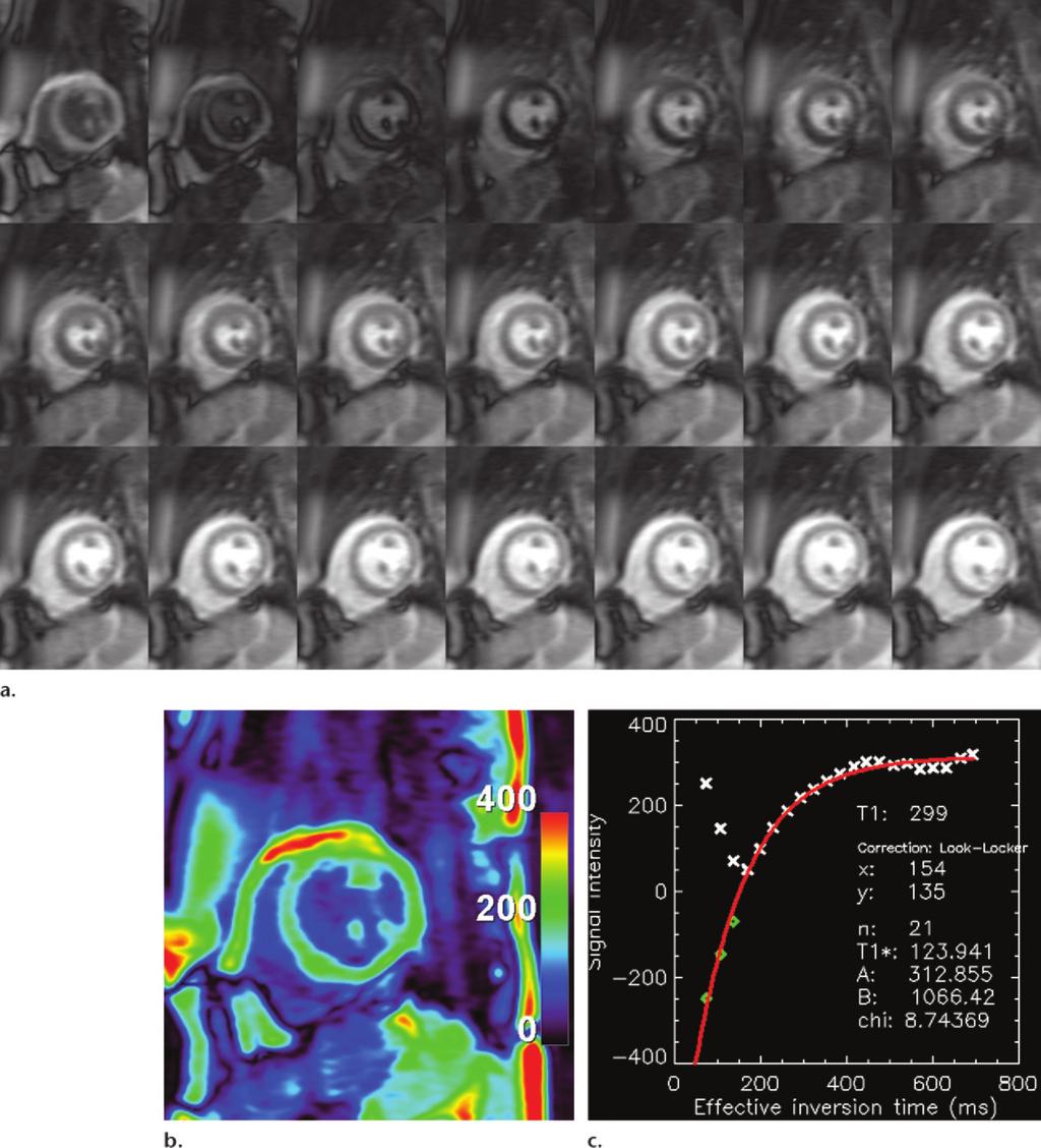1596 October Special Issue 2014 radiographics.rsna.org Figure 1. T1 mapping with a Look-Locker (LL) MR imaging sequence in a healthy 34-year-old man with normal myocardium.