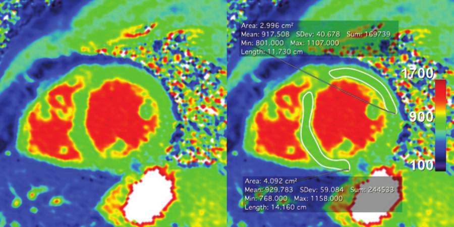 1598 October Special Issue 2014 radiographics.rsna.org Figure 3. T1 maps obtained with a nonenhanced MOLLI MR imaging sequence at 1.