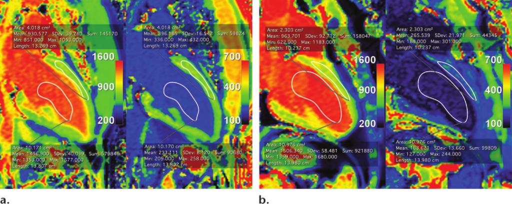 RG Volume 34 Number 6 Hamlin et al 1601 Figure 4. T1 mapping with ECV calculations in patients with healthy and diseased myocardium. (Scale is in milliseconds.) (a) T1 maps show a normal ECV (23.