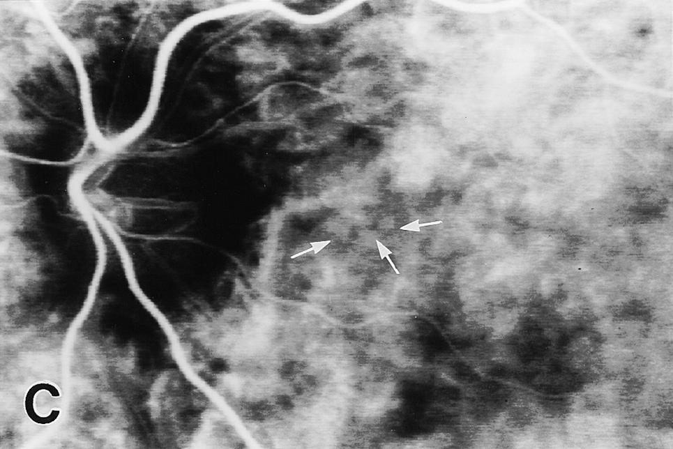 Dilatation and tortuosity of the choroidal vessels in the posterior pole were also detected by IA.