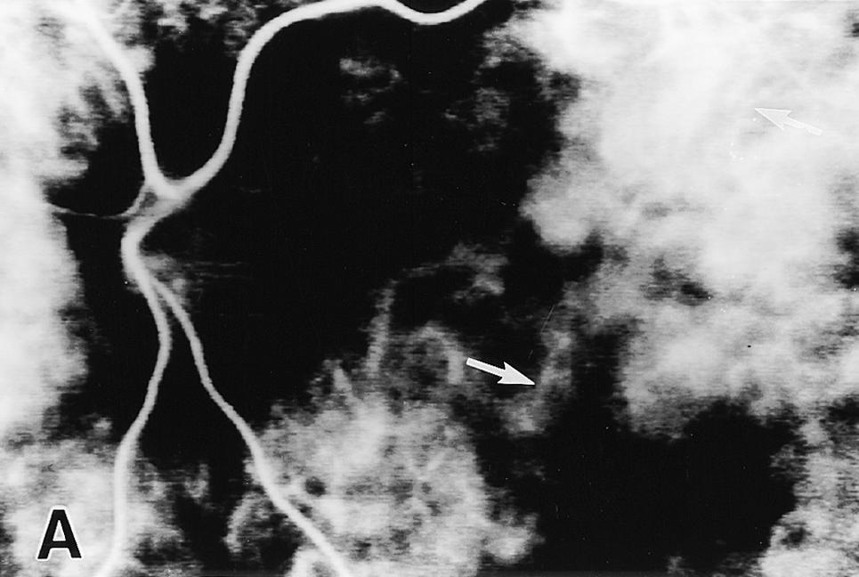 (A D) ICG angiograms showing lobular filling pattern every second.