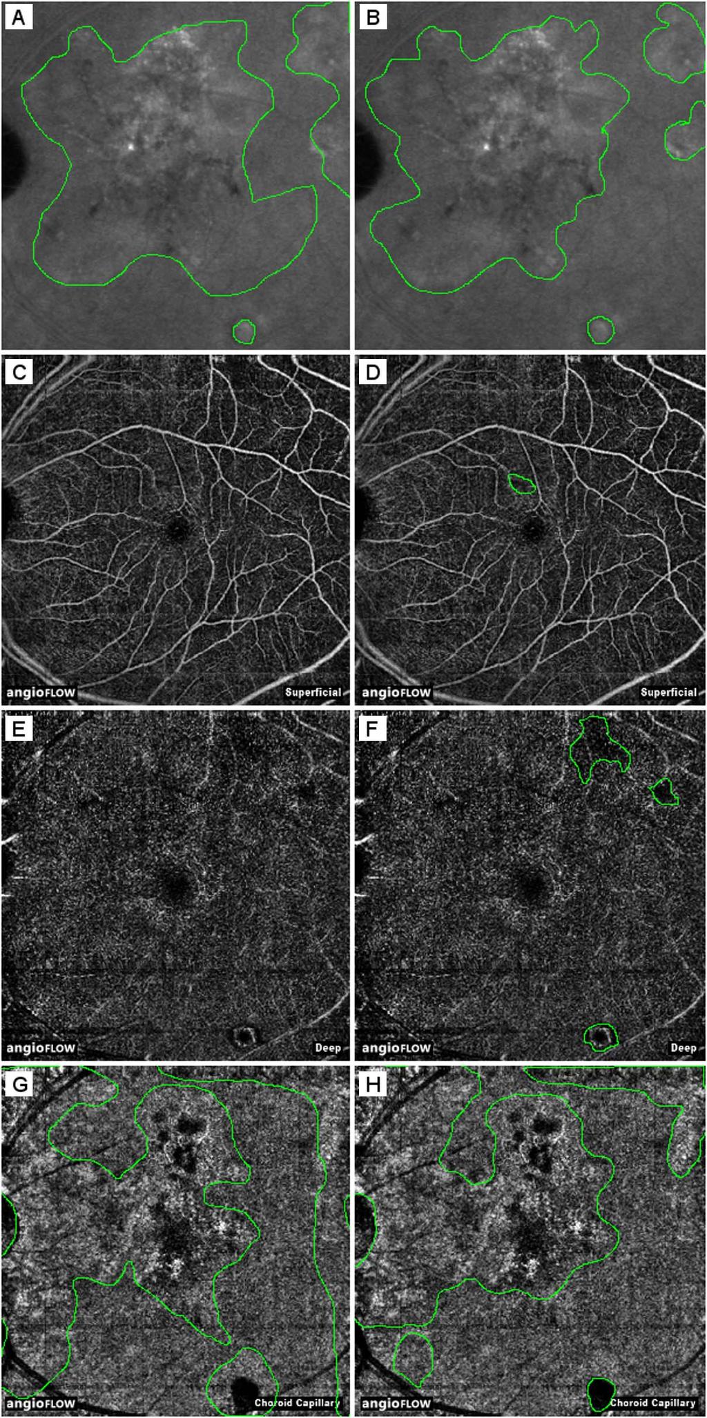 Angio-OCT, FA, and ICGA in Chronic CSC IOVS j August 2015 j Vol. 56 j No. 9 j 5234 FIGURE 5. Examples of image annotations. (A, B) Late-phase ICGA images (left eye of patient 8, 6 3 6 mm).