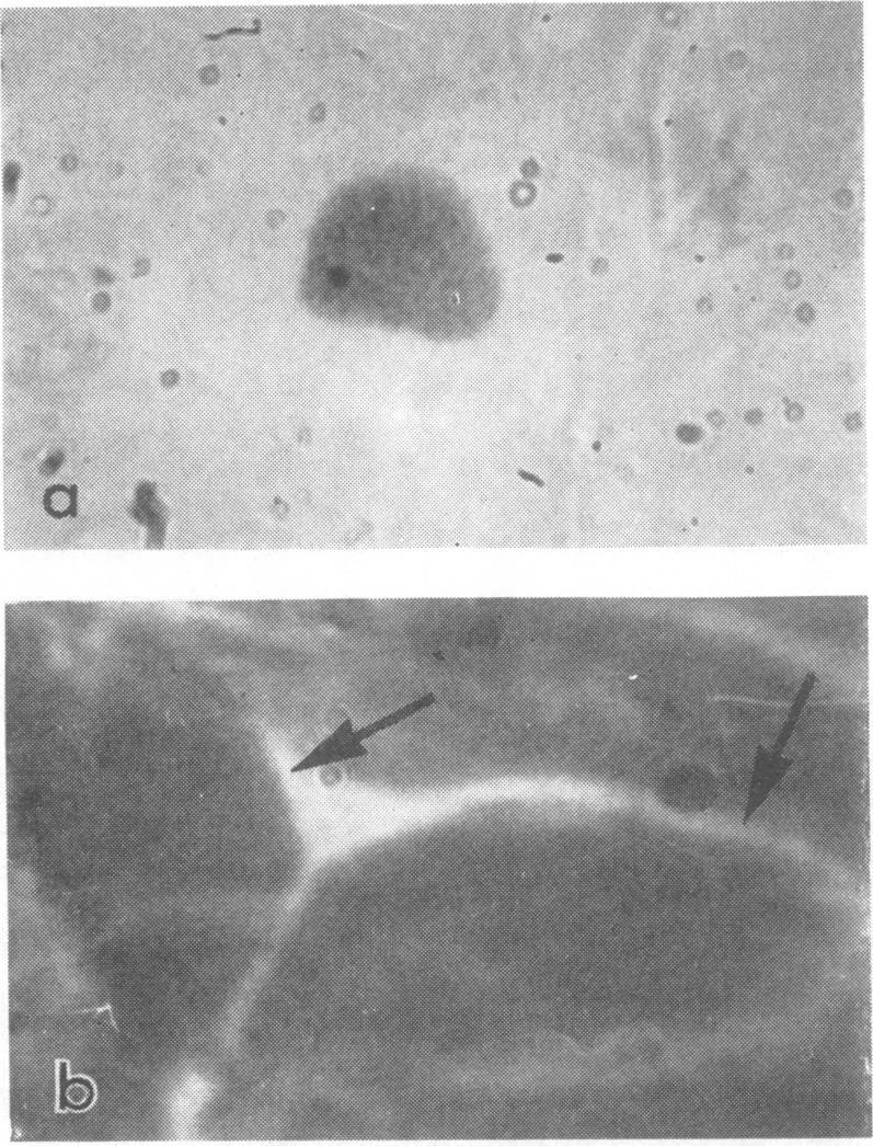 Iodine stining (Rice, 1936; Gilkes, Smith, nd Sow, 1958), which is invluble for the rpid demonstrtion of inclusions in conjunctivl scrpings (Fig.