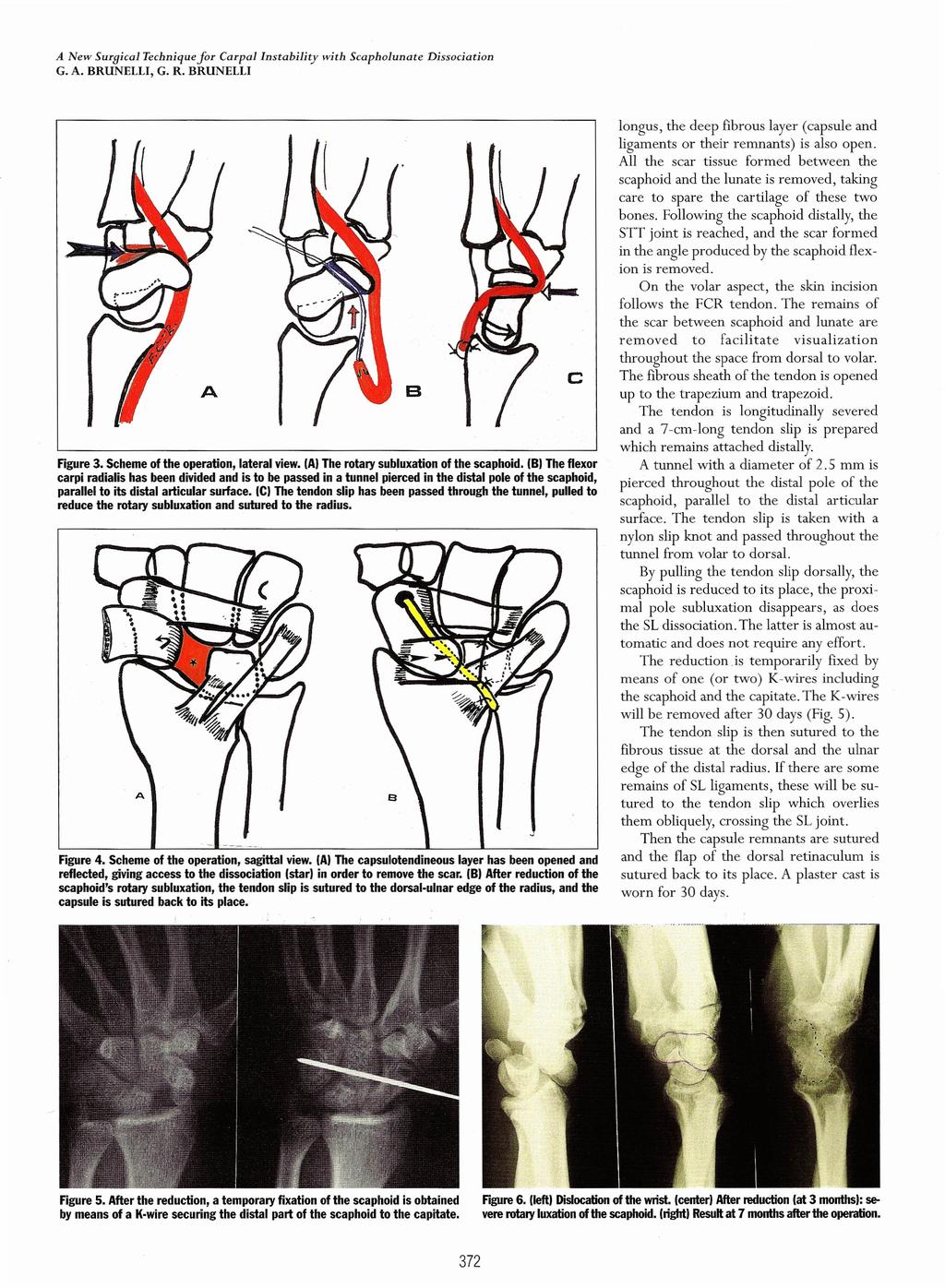 A New Surpical Techniquefor Carpal Instability with Scapholunate Dissociation B Figure 3. Scheme of the operation, lateral view. (A) The rotary subluxation of the scaphoid.