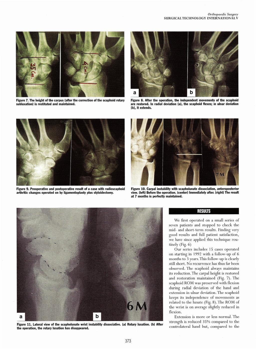 SURGICAL TECHNOLOGY Orthopaedic Surqery INTERNATIONAL V Figure 7. The height of the carpus (after the correction of the scaphoid rotary subluxation) is restituted and maintained. Figure 8.