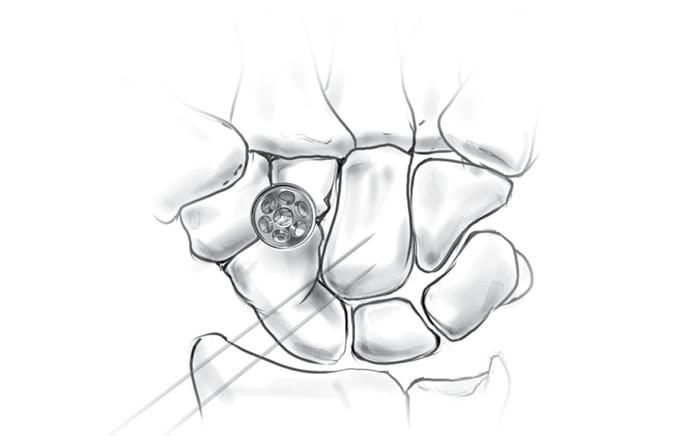 Step 4 Denude the Cartilage 4-1 A small rongeur is used to denude the cartilage between the three bones down through subchondral bone to good cancellous bone.