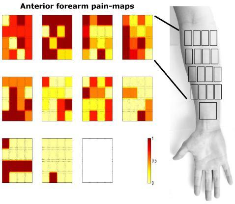 48 Chapter 5. Pain-maps Figure 5.4: Normalized pain ratings of 11 patients for the anterior forearm.