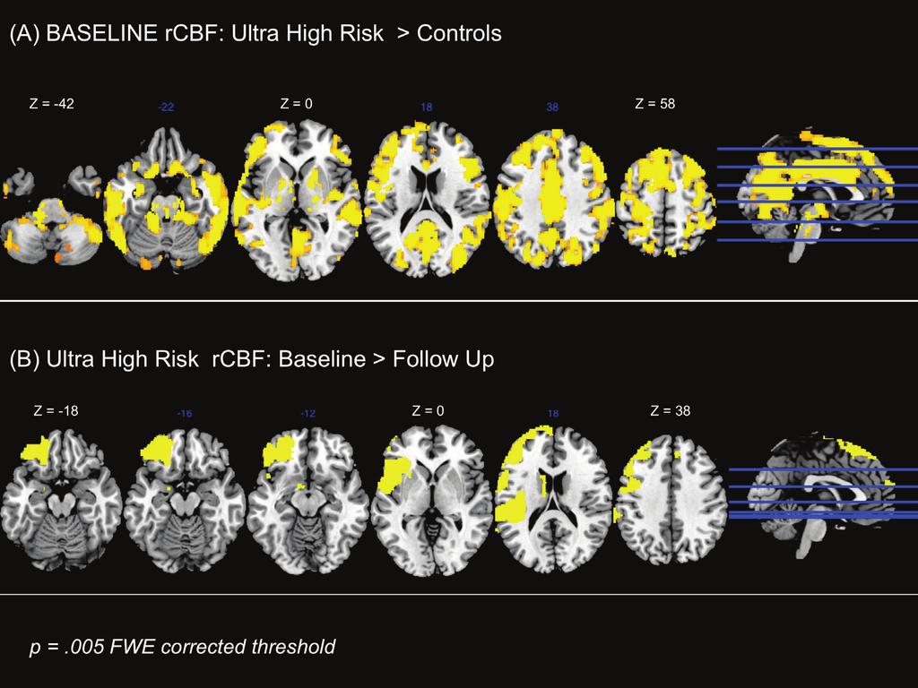 Supplementary Figures Legend Figure S1: Whole brain activation maps (axial orientation) showing rcbf differences