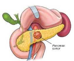 Pancreatic ductal adenocarcinoma Poor prognosis Highly metastatic