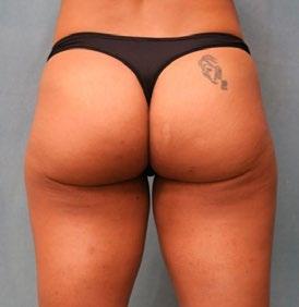 15 80 % of patients felt their buttock was more lifted and toned right after their last treatment. Patients reported improvement in buttock laxity and tightness post-treatment.