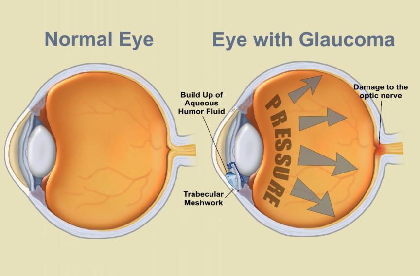 Clinical Uses The Eye In the past, glaucoma was treated with pilocarpine, methacholine, carbachol) or ChEIs physostigmine, demecarium, echothiophate, isoflurophate).