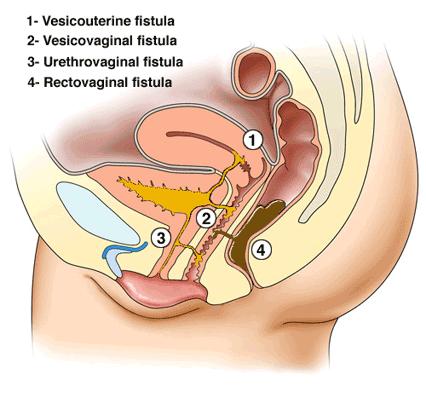Urogenital fistula http://www.