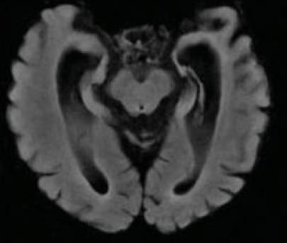 Structural imaging: MRI Alzheimer s: Medial temporal atrophy Frontotemporal