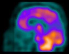 Metabolic imaging: less common techniques SPECT: radionuclide technique that measures cerebral blood flow Expect temporo-parietal hypoperfusion in AD fmri: measures blood flow as