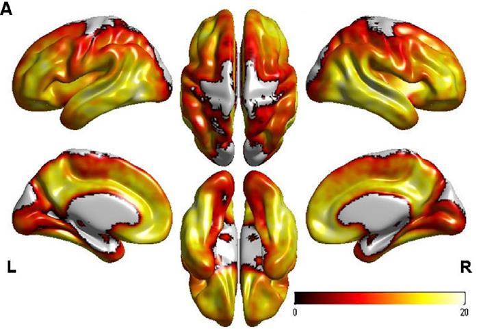 Molecular imaging: amyloid PET imaging can track amyloid deposition, even before clinical symptoms