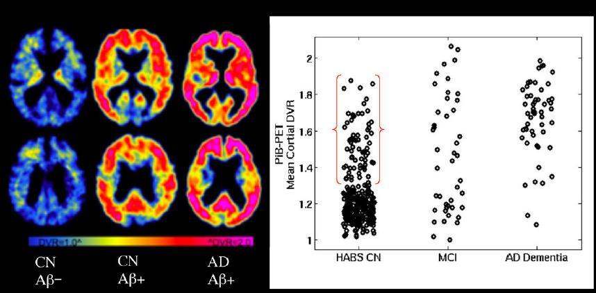 Molecular imaging: amyloid Amyloid PET has high negative predictive value but low positive