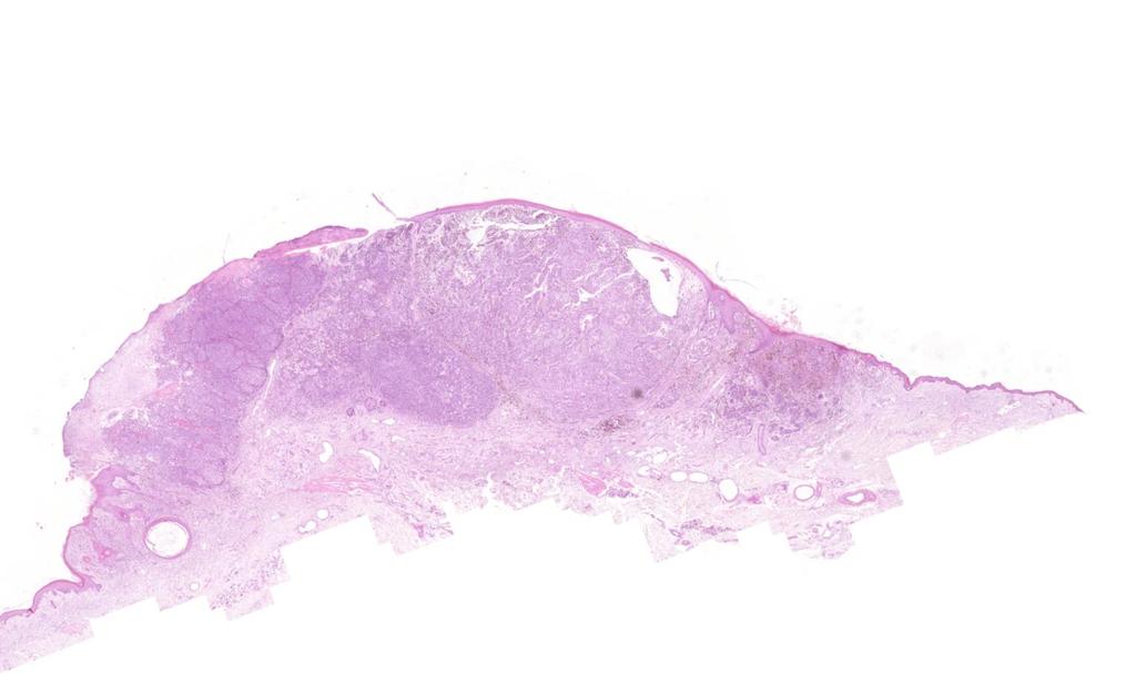 Breslow thickness: distance of the epidermal granular cell layer above the tumor cells and