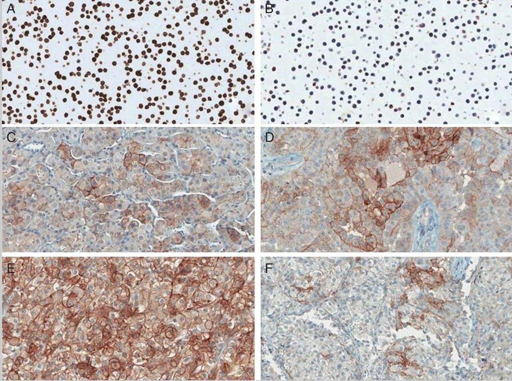 PD-L1 Expression in Non-Clear Cell RCC 11/101 (10.9%) were PD-L1+ in tumor cells: 2/36 (5.6%) of chromophobe RCC 5/50 (10%) of papillary RCC 3/10 (30%) of Xp11.