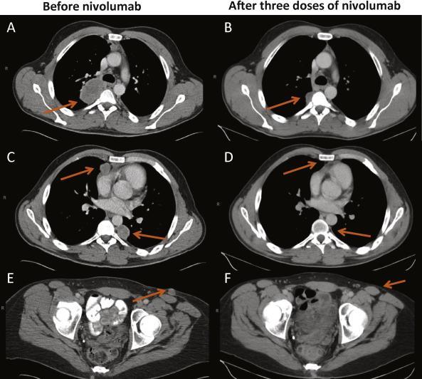 Activity of Nivolumab in Papillary RCC 34-yr-old man presented with night sweats, fevers, pulmonary masses, bony disease, and a left renal mass Lung biopsy: Poorly differentiated carcinoma with