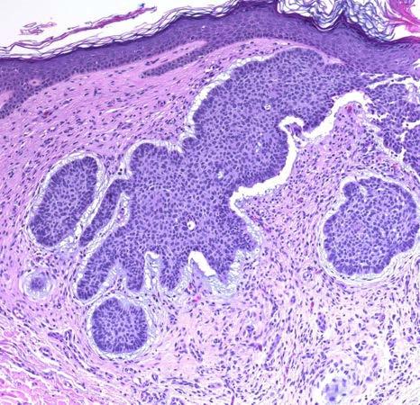 Basal cell carcinoma: basaloid islands invade