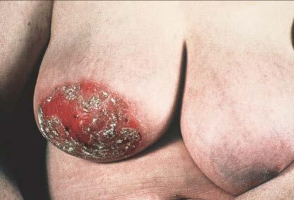 Paget s disease of the breast