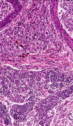 Melanoma arising in a congenital naevus: large melanoma