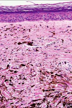 dendritic spindled melanocytes