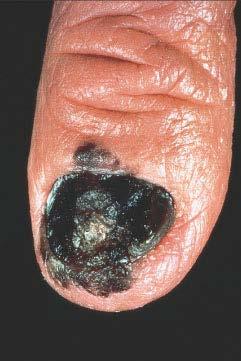 Acral lentiginous melanoma Subungual melanoma