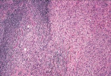 Sentinel lymph node examination Performed in cases of melanomas of Breslow depth 1-4mm Lymph node draining the area of melanoma is detected using radioactive tracer and blue dye Lymph node is excised