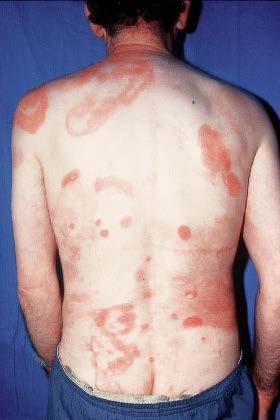 Mycosis fungoides Commonest