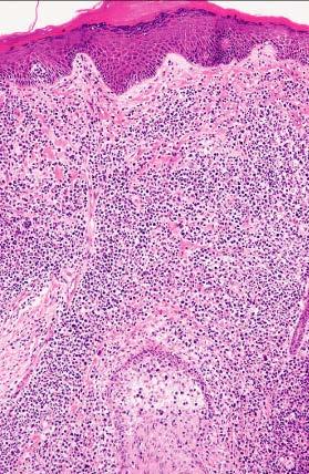 Tumour stage mycosis