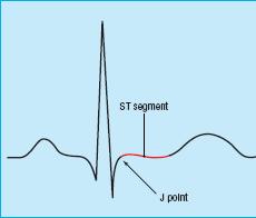 Step 6: ST Segments From end of QRS