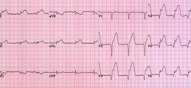 75 yo. Central crushing chest pain & SOB. PMH- HTN/CCF DH- Frusemide/amlodipine SH- Smoker What is the main abnormality?